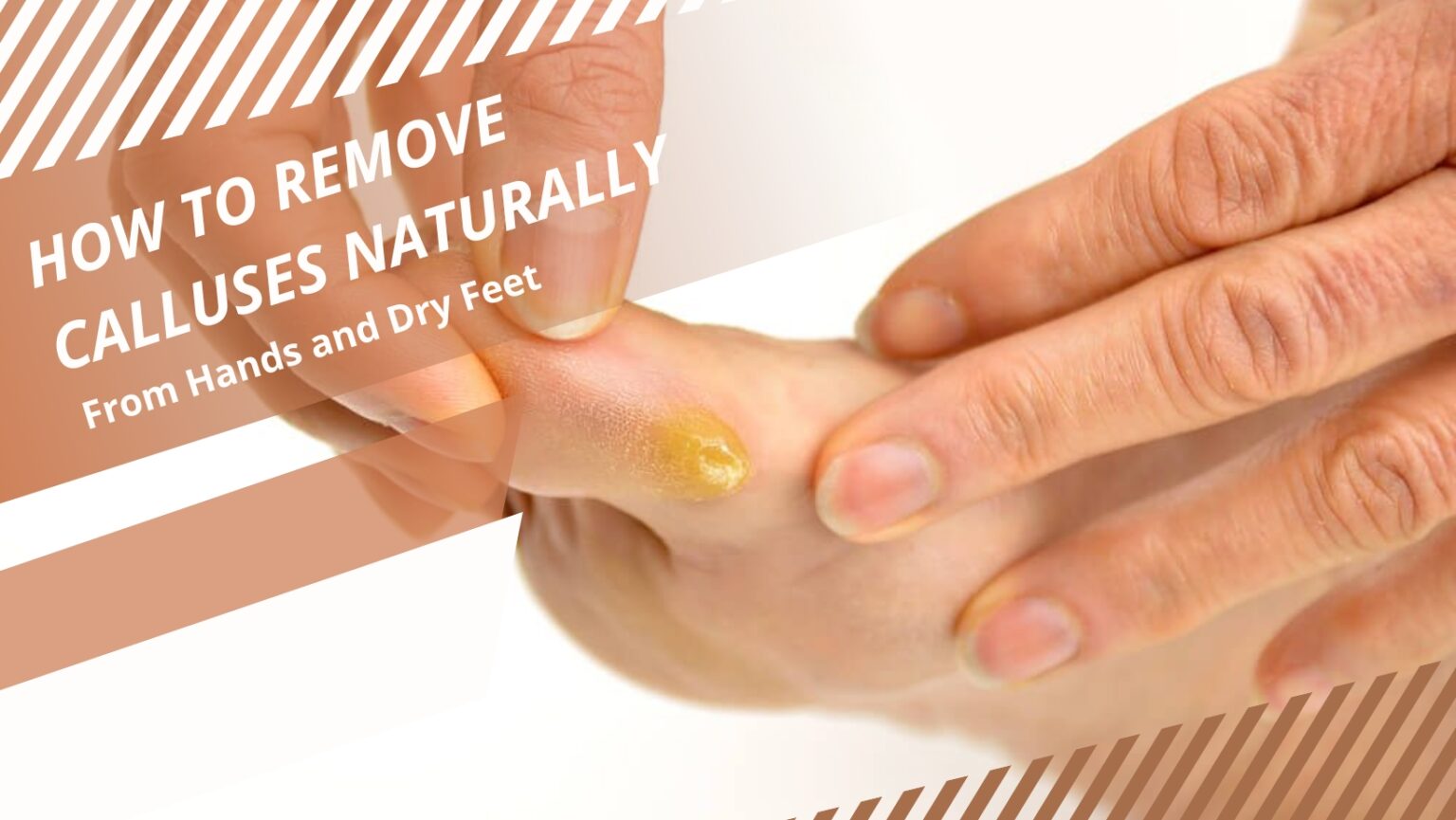 9 Tips for How To Remove Calluses Naturally From Hands and Dry Feet
